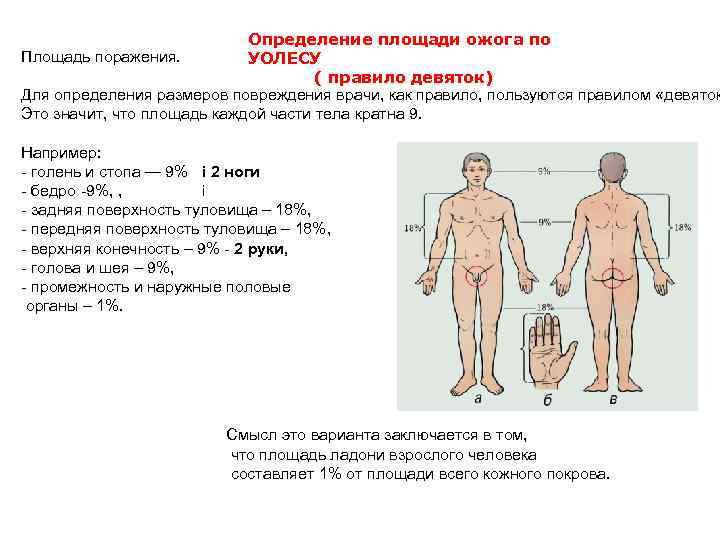 Правила определения площади ожогов