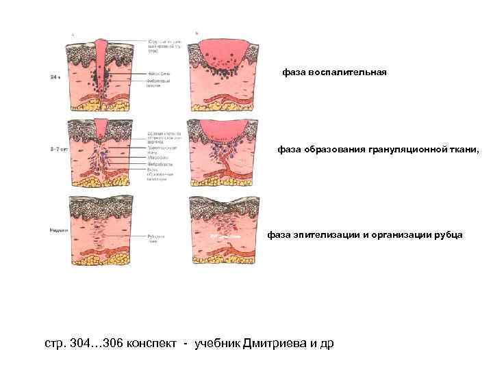  фаза воспалительная фаза образования грануляционной ткани, фаза эпителизации и организации рубца стр. 304…