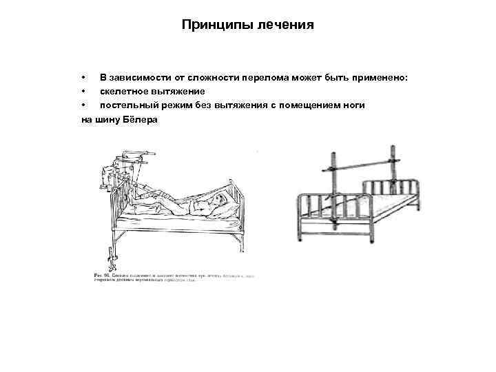 Принципы лечения • В зависимости от сложности перелома может быть применено: • скелетное вытяжение