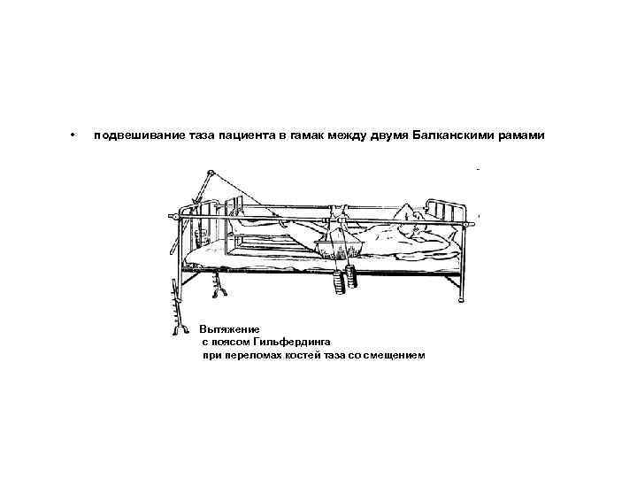  • подвешивание таза пациента в гамак между двумя Балканскими рамами Вытяжение с поясом