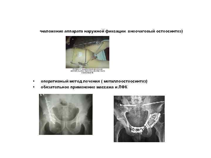  • наложение аппарата наружной фиксации внеочаговый остеосинтез) • • оперативный метод лечения (