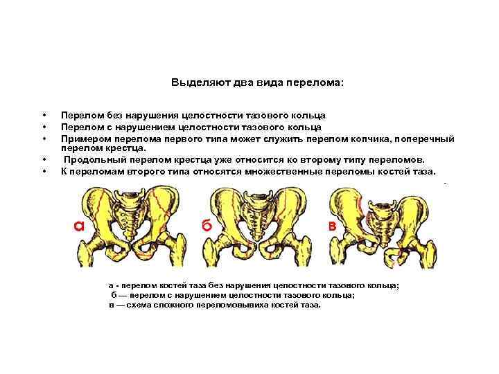 Выделяют два вида перелома: • • • Перелом без нарушения целостности тазового кольца Перелом