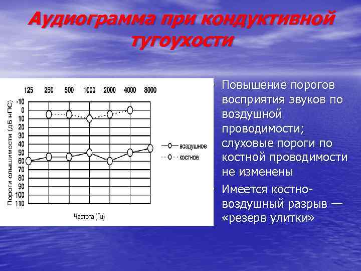 Аудиограмма при кондуктивной тугоухости • Повышение порогов • восприятия звуков по воздушной проводимости; слуховые