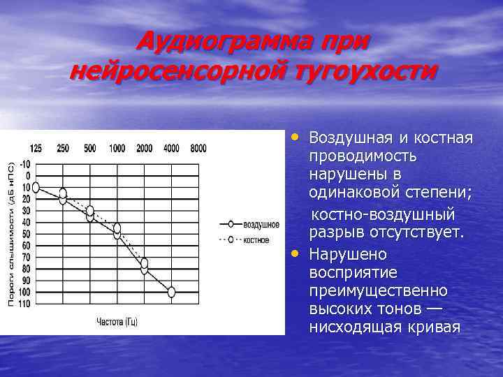 Аудиограмма при нейросенсорной тугоухости • Воздушная и костная • проводимость нарушены в одинаковой степени;