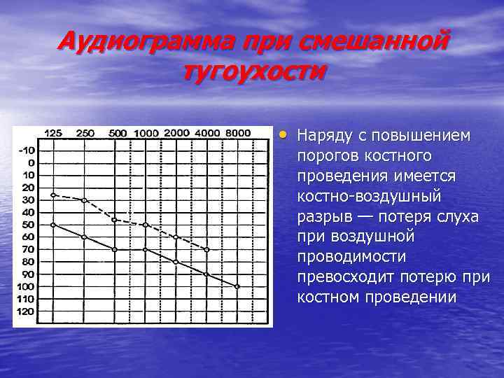 Аудиограмма при смешанной тугоухости • Наряду с повышением порогов костного проведения имеется костно-воздушный разрыв