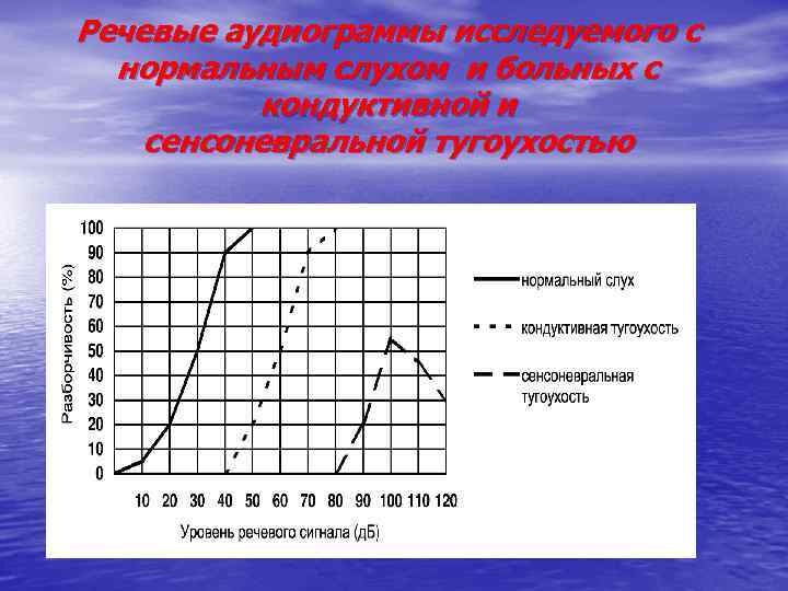 Речевые аудиограммы исследуемого с нормальным слухом и больных с кондуктивной и сенсоневральной тугоухостью 