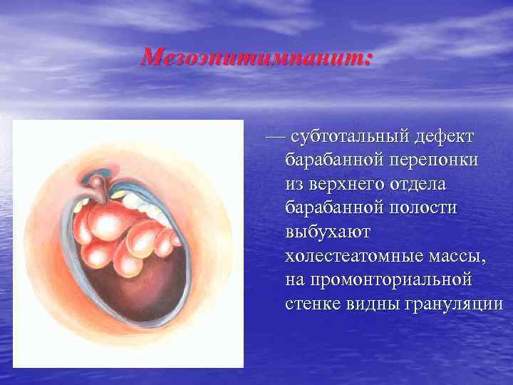 Мезоэпитимпанит: — субтотальный дефект барабанной перепонки из верхнего отдела барабанной полости выбухают холестеатомные массы,