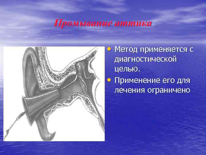 Промывание аттика • Метод применяется с • диагностической целью. Применение его для лечения ограничено