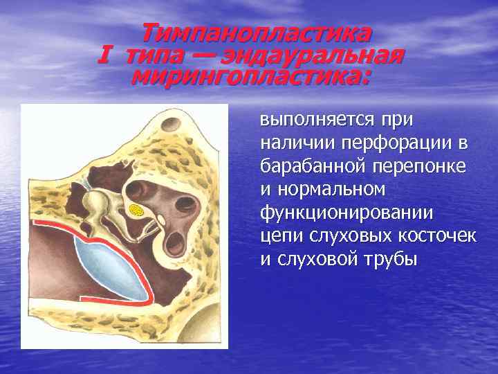 Тимпанопластика I типа — эндауральная мирингопластика: выполняется при наличии перфорации в барабанной перепонке и