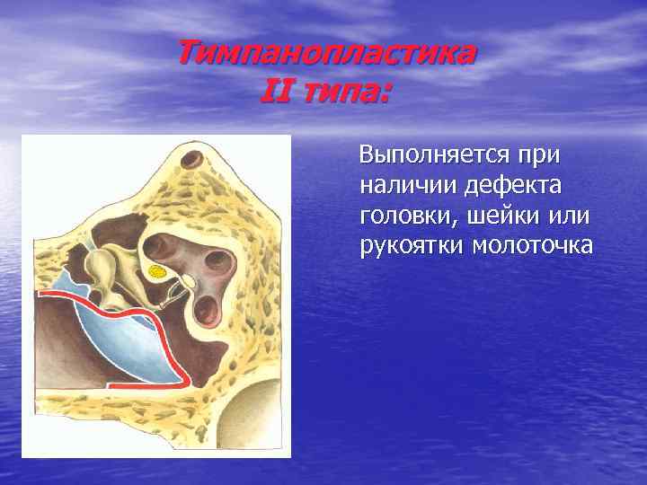 Тимпанопластика II типа: Выполняется при наличии дефекта головки, шейки или рукоятки молоточка 