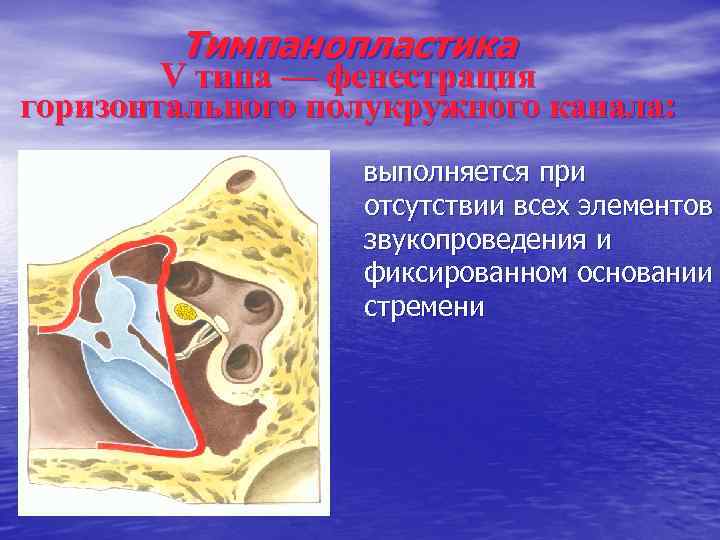 Тимпанопластика V типа — фенестрация горизонтального полукружного канала: выполняется при отсутствии всех элементов звукопроведения