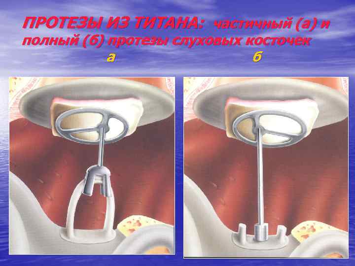 ПРОТЕЗЫ ИЗ ТИТАНА: частичный (а) и полный (б) протезы слуховых косточек а б 