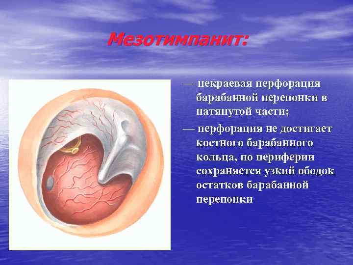 Мезотимпанит: — некраевая перфорация барабанной перепонки в натянутой части; — перфорация не достигает костного