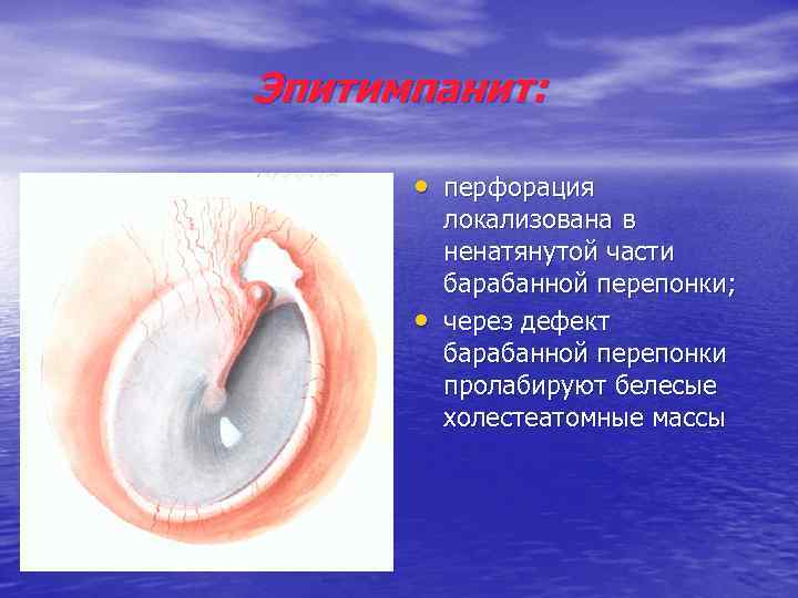 Эпитимпанит: • перфорация • локализована в ненатянутой части барабанной перепонки; через дефект барабанной перепонки