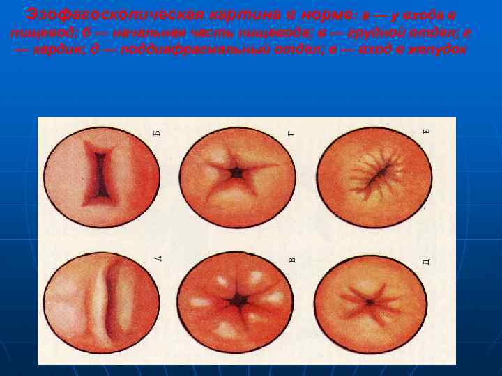 Эзофагоскопическая картина в норме: а — у входа в пищевод; б — начальная часть