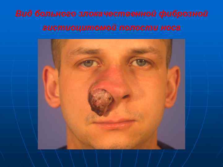 Вид больного злокачественной фиброзной гистиоцитомой полости носа 