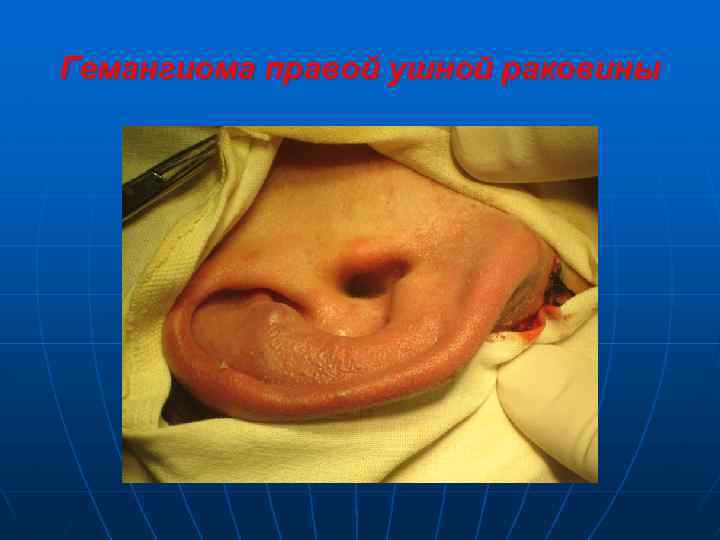 Гемангиома правой ушной раковины 