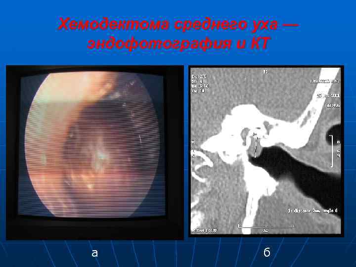 Хемодектома среднего уха — эндофотография и КТ а б 
