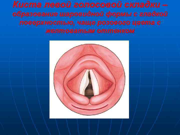 Киста левой голосовой складки – образование шаровидной формы с гладкой поверхностью, чаще розового цвета