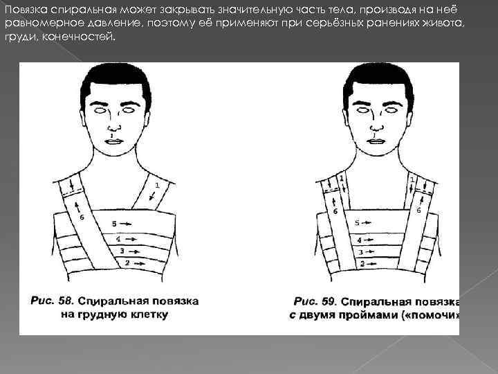 Повязка гиппократа алгоритм. Спиральная повязка. Спиральная повязка Гиппократа. Наложение спиральной повязки. Спиральная повязка на грудь.