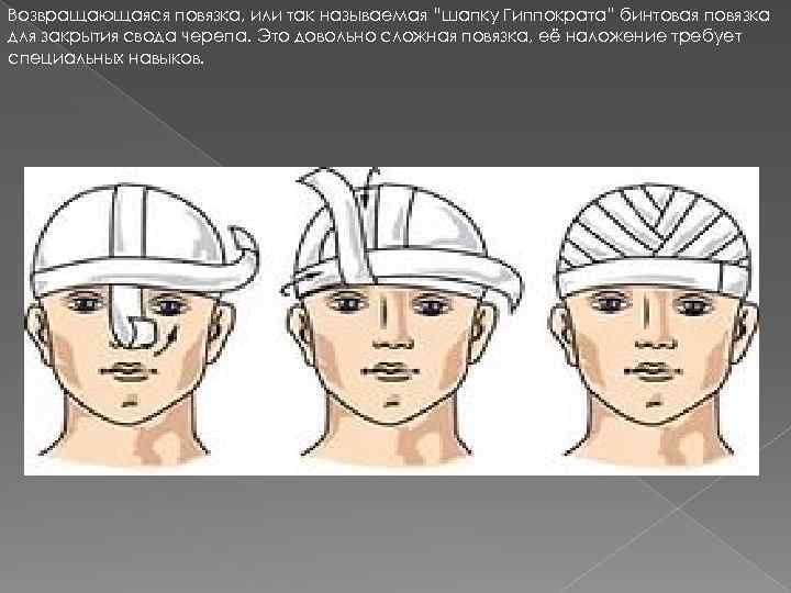 Возвращающаяся повязка, или так называемая “шапку Гиппократа” бинтовая повязка для закрытия свода черепа. Это