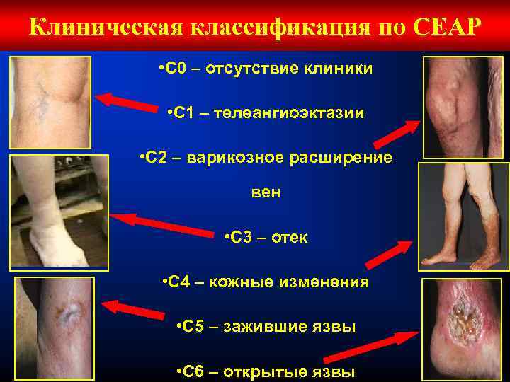 Клиническая классификация по СЕАР • С 0 – отсутствие клиники • С 1 –