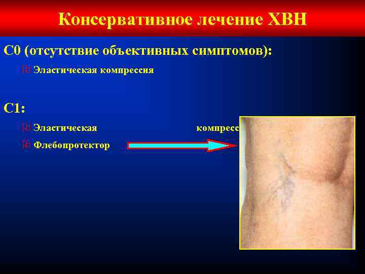 Консервативное лечение ХВН С 0 (отсутствие объективных симптомов): O Эластическая компрессия С 1: O