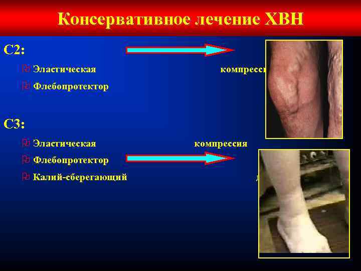 Консервативное лечение ХВН С 2: O Эластическая компрессия O Флебопротектор С 3: O Эластическая