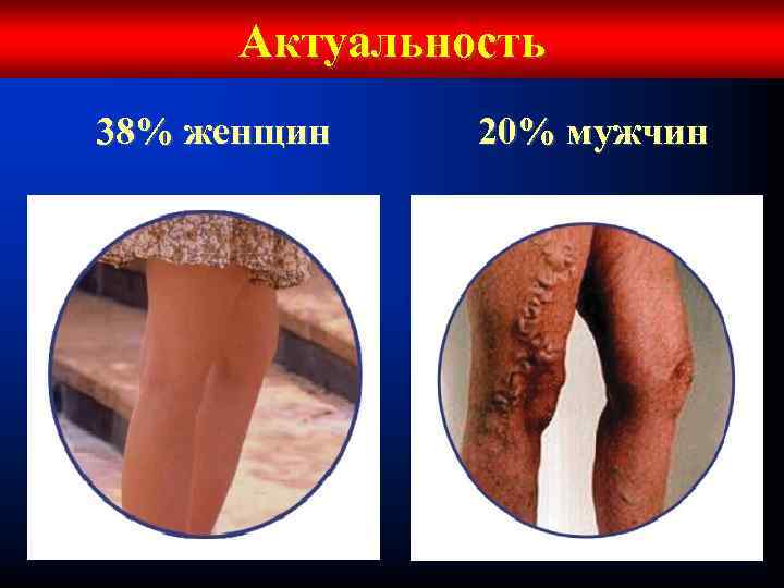 Актуальность 38% женщин 20% мужчин 