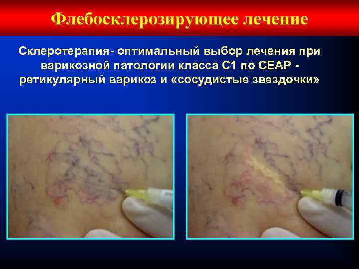 Флебосклерозирующее лечение Склеротерапия- оптимальный выбор лечения при варикозной патологии класса С 1 по СЕАР