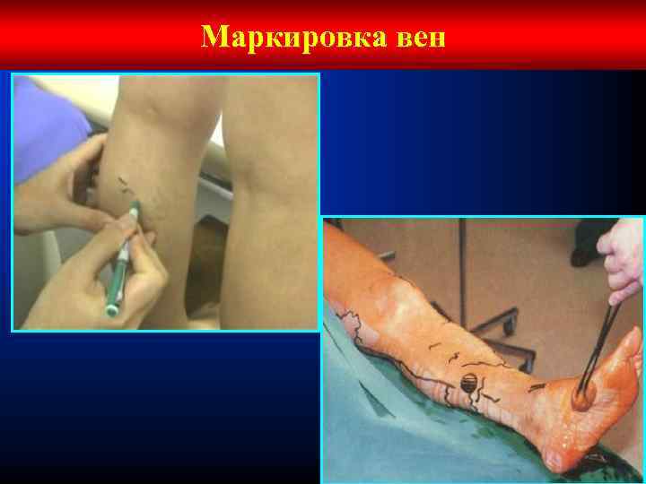 Маркировка вен 