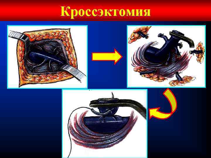 Кроссэктомия 