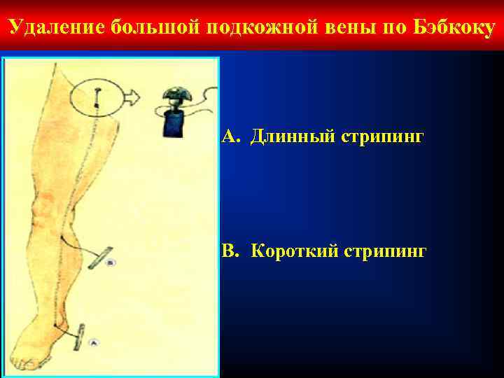 Удаление большой подкожной вены по Бэбкоку A. Длинный стрипинг B. Короткий стрипинг 