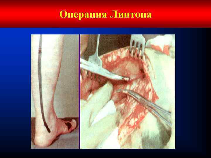 Операция Линтона 