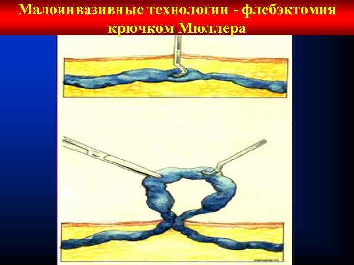 Малоинвазивные технологии - флебэктомия крючком Мюллера 