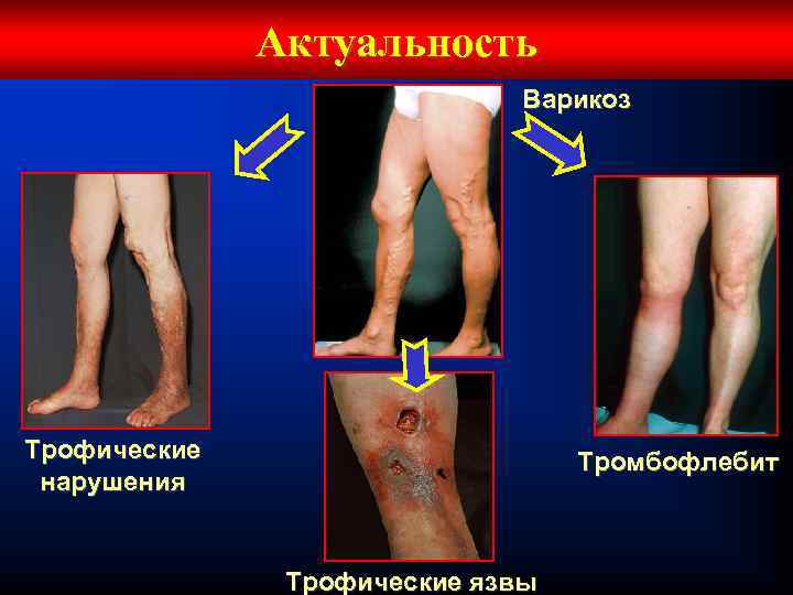 Актуальность Варикоз Трофические нарушения Тромбофлебит Трофические язвы 