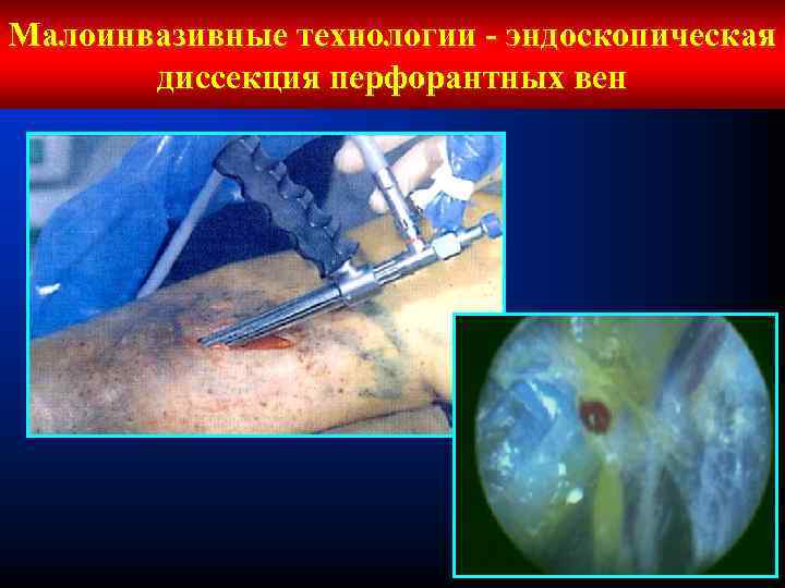 Малоинвазивные технологии - эндоскопическая диссекция перфорантных вен 