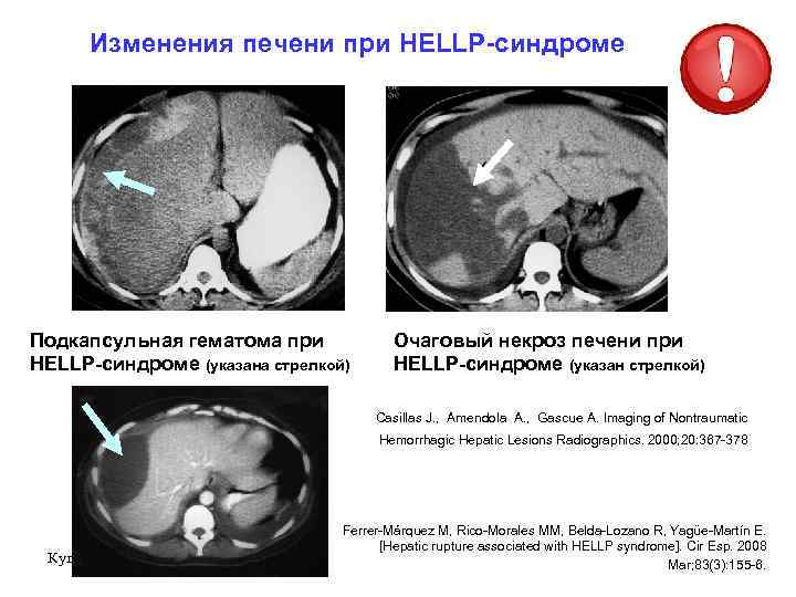 Изменения печени при HELLP-синдроме Подкапсульная гематома при HELLP-синдроме (указана стрелкой) Очаговый некроз печени при