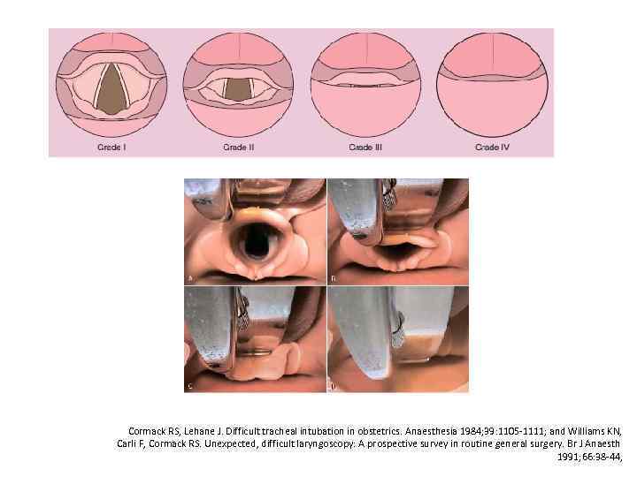 Cormack RS, Lehane J. Difficult tracheal intubation in obstetrics. Anaesthesia 1984; 39: 1105 -1111;