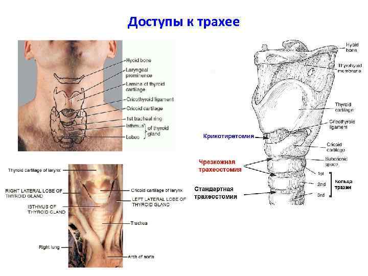 Доступы к трахее 