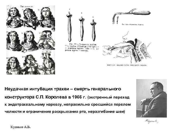 Неудачная интубация трахеи – смерть генерального конструктора С. П. Королева в 1966 г. (экстренный