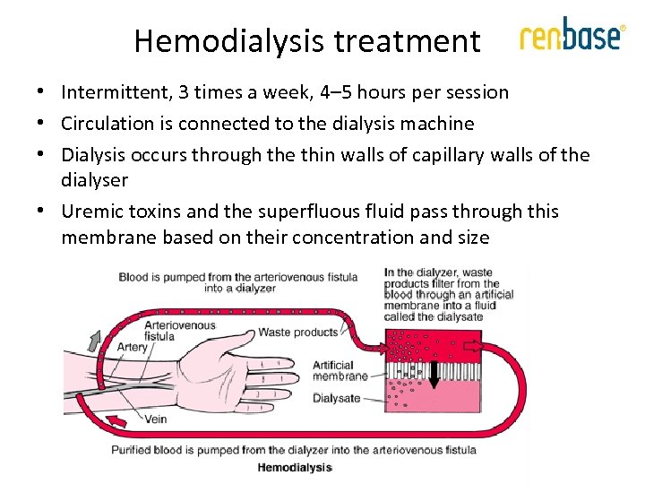 Hemodialysis treatment • Intermittent, 3 times a week, 4– 5 hours per session •