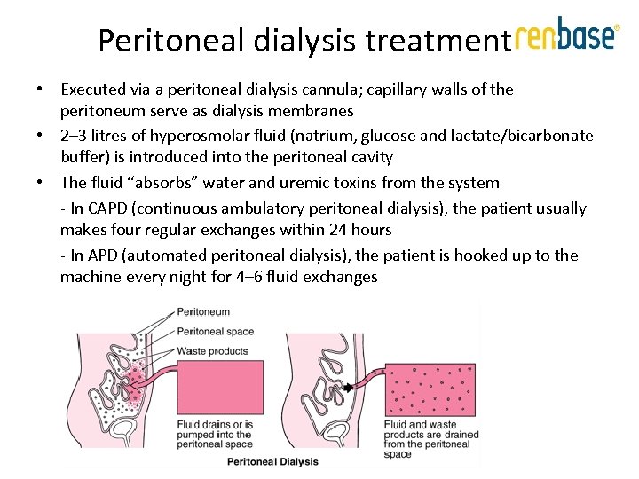 Peritoneal dialysis treatment • Executed via a peritoneal dialysis cannula; capillary walls of the