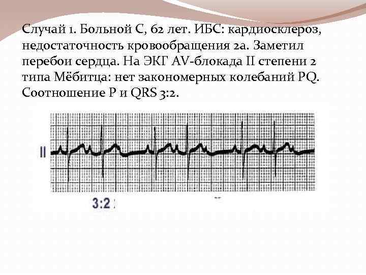 Случай 1. Больной С, 62 лет. ИБС: кардиосклероз, недостаточность кровообращения 2 а. Заметил перебои