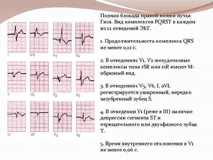 Полная блокада правой ножки пучка Гиса. Вид комплексов PQRST в каждом из 12 отведений