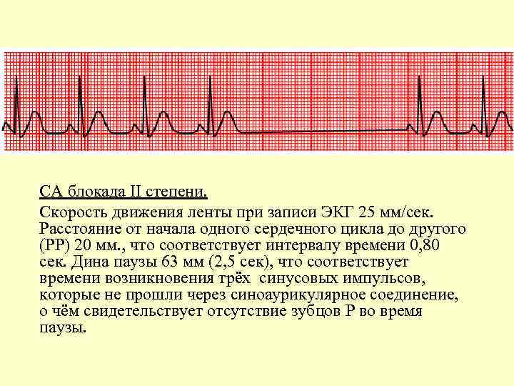 СА блокада II степени. Скорость движения ленты при записи ЭКГ 25 мм/сек. Расстояние от