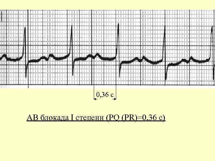 0, 36 с АВ блокада I степени (PQ (PR)=0, 36 с) 