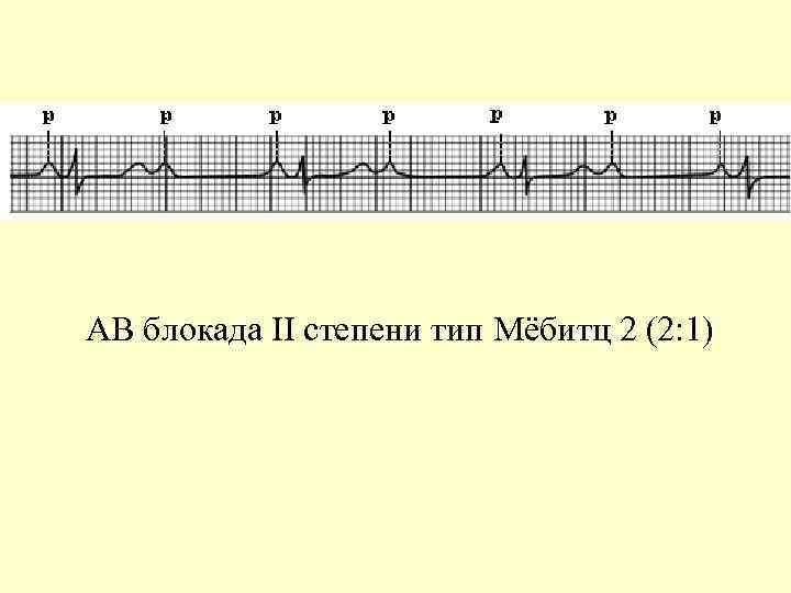 АВ блокада II степени тип Мёбитц 2 (2: 1) 