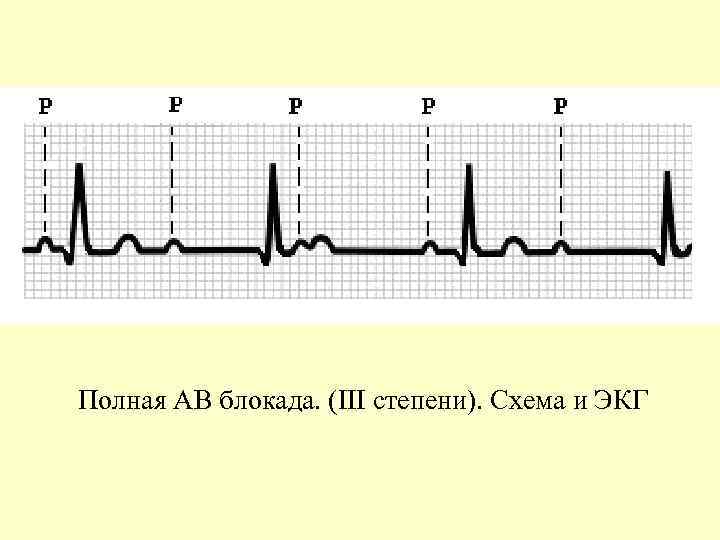 Полная АВ блокада. (III степени). Схема и ЭКГ 