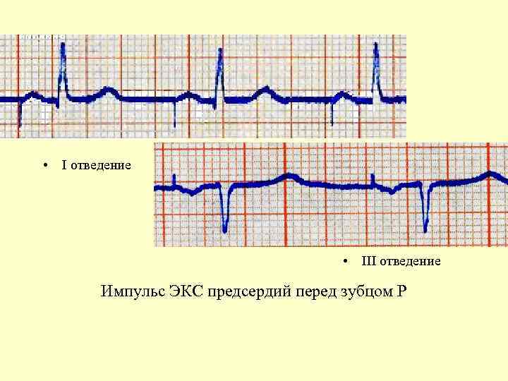  • I отведение • III отведение Импульс ЭКС предсердий перед зубцом Р 